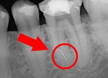 Usuwanie złamanego narzędzia z zęba – resekcja korzenia